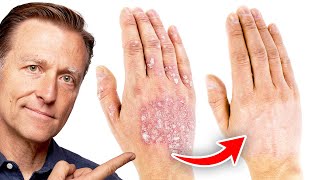 The 1 Best Remedy for Eczema [upl. by Chema]