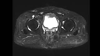 Iliopsoas bursitis [upl. by Hamlen]