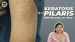 Keratosis Pilaris  Chicken Skin  How to treat Keratosis Pilaris Hindi  Dr Nivedita Dadu [upl. by Hyrup277]