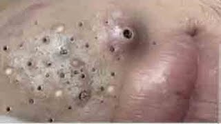 Big Cystic Acne Blackheads Extraction Blackheads amp Milia Whiteheads Removal Pimple Popping  4512 [upl. by Ber]