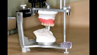 Clinical Remount of Complete Dentures [upl. by Ikaz]