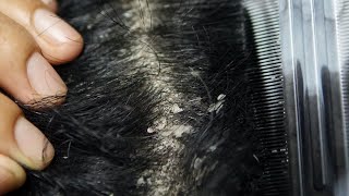 Big Dandruff Flakes in Hair Removal Huge Flakes [upl. by Eustis]