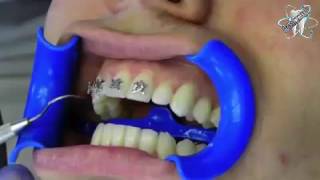 Watch how dentist put your braces on [upl. by Gaskill]