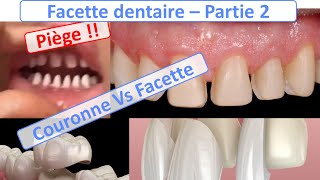 Facette dentaire  Facette Vs Couronnes Piège à éviter  Guide complet  partie 2 [upl. by Anaibaf]