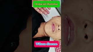 Orofacial dyskinesia  oromandibular dystonia  wilson disease [upl. by Dnartreb506]