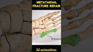 Metatarsal Fracture Repair Process shorts viral metatarsal fracture [upl. by Anaimad]