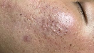 ACNE TREATMENT VU QUYNH MI Blackheads On Boy Face 2024 [upl. by Harte]