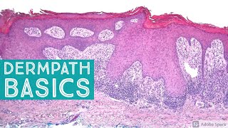 Basic Dermpath Cases  Explained by a Dermatopathologist [upl. by Gilbertina305]