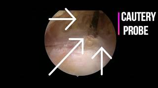 Hip Bursitis Surgery  Arthroscopic removal of hip bursitis [upl. by Perri66]