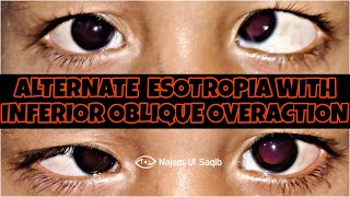 SquintStrabismus Examination  Alternate Esotropia With Inferior Oblique Overaction [upl. by Fabien668]