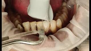 Teeth cleaning removing tough smoking stains [upl. by Angus]