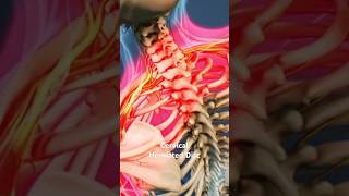 Cervical Herniated Disc [upl. by Assyli534]