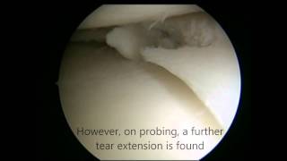 Knee Meniscal Tear Treatment  Keyhole Surgery Arthroscopy [upl. by Dela577]