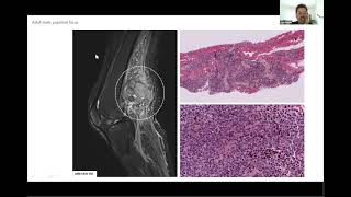 Molecular characterization of mesenchymal tumors promises and challenges [upl. by Ailema664]