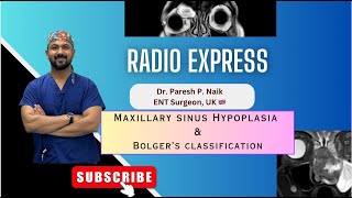 Maxillary sinus hypoplasia amp Bolger Classification [upl. by Ube]