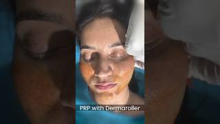 Dermaroller and PRP treatment for acne scar and Collagen Boost at Skinaa Clinic shorts viral [upl. by Luby]