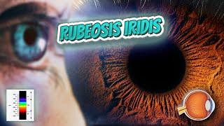 Rubeosis iridis Your EYEBALLS 👁️👁️💉😳💊🔊💯✅ [upl. by Ahsiaa787]