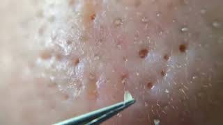 Relaxing Blackhead Removal with Tweezer [upl. by Ynelram762]