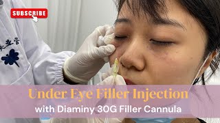 Under eye filler injection with 30G filler cannula [upl. by Harehs]