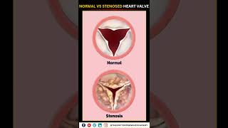 Normal vs Narrowed Stenosed Heart Valve education neet biology heart [upl. by Dall]