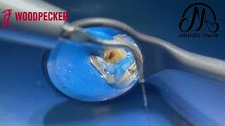 Irrigation Activation Protocol using Woodpecker ENDO1 Ultrasonic Device  PUI Technique  Root Canal [upl. by Yspyg]