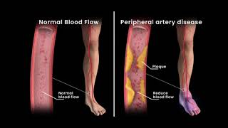 Peripheral Artery Disease Angioplasty [upl. by Keene]