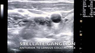 Ultrasound Guided Stellate Ganglion Block [upl. by Socher]