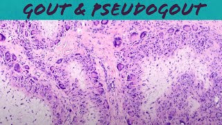 Gout amp Pseudogout calcium pyrophosphate deposition disease  chondrocalcinosis pathology USMLE [upl. by Trebeh]