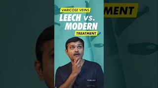 Can Leech Therapy REALLY Cure Varicose Veins [upl. by Eserahc]