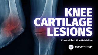 Knee Cartilage Lesions  Physiotherapy Guideline [upl. by Lewie]