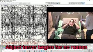 TRIGGER WARNING Tonic clonic grand mal epilepsy seizure with brain wave recording 3rd of 3 [upl. by Tiras597]