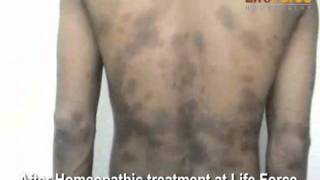 Psoriasis Vulgaris Spots on Face Forehead Chest Arms amp Back Treatment at Life Force [upl. by Terena973]