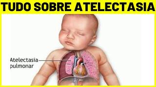 ATELECTASIA PULMONAR  O QUE É CAUSAS SINTOMAS E TRATAMENTO [upl. by Aan]