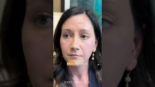 Removing UnderEye Filler Before Trifecta Lift  Dr Kami Parsa [upl. by Lucius]