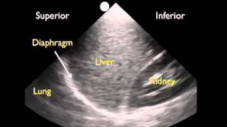 How To Ultrasound Detection of Pleural Fluid Case Study Video [upl. by Etselec]