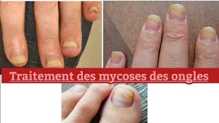 Traitement naturel des mycoses des ongles [upl. by Allerym999]