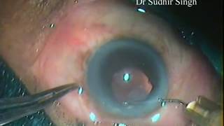 Surgical Capsulotomy By Dr Sudhir Singh [upl. by Karrie]