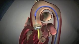 Transcatheter Aortic Valve Implantation TAVI [upl. by Wesle]