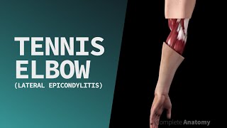 Tennis Elbow Lateral Epicondylitis [upl. by Goldia]