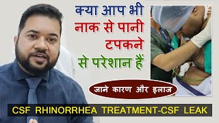 CSF RHINORRHEA TREATMENTCSF LEAK  Hindi  Dr Vikram Bhardwaj [upl. by Anabella]