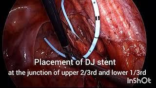 LAPAROSCOPIC URETEROLITHOTOMY FOR LOWER URETERIC STONE [upl. by Latona183]