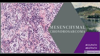 Mesenchymal chondrosarcoma [upl. by Nauaj]