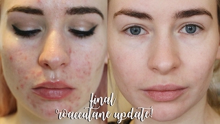 FINAL 8 MONTH ROACCUTANE UPDATE [upl. by Horan]