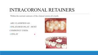 TREATMENT PLANNING FOR FIXED PROSTHODONTICS CONVENTIONAL BRIDGES AND DIAGNOSTIC WAX UP [upl. by Zanahs]