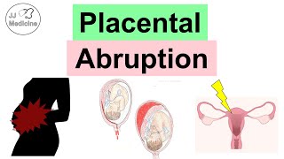 Placental Abruption Abruptio Placentae Risk Factors Symptoms Complications Diagnosis Treatment [upl. by Philbin]