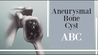 What is an Aneurysmal Bone Cyst Symptoms Causes Diagnosis and Treatment [upl. by Ponce219]