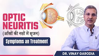 What is Optic Neuritis  Symptoms and Treatment  Synergy Eye Care [upl. by Dlaner]