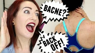 BACNE HOW TO REMOVE BODY amp BACK ACNE Bacne Home Remedies amp Treatments [upl. by Arua821]