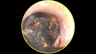 Tympanic membrane perforation and postoperative debridement for cholesteatoma 57 [upl. by Yatnahc]