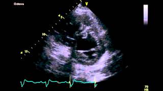 Left Atrial and Ventricular Thrombus  Transthoracic Echocardiogram TTE [upl. by Xuaeb737]